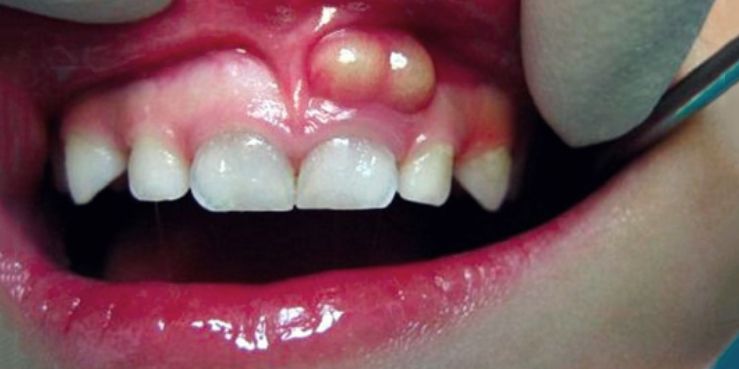عفونت شدید دندان