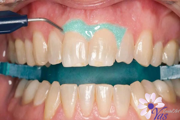 انواع روش بلیچینک دندان