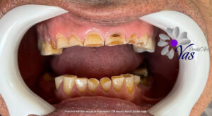 پروتز دندان و روكش دندان